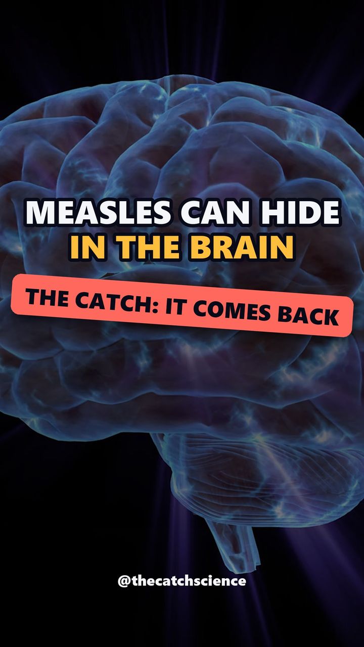 MEASLES CAN HIDE IN THE BRAIN. The catch: It comes back
